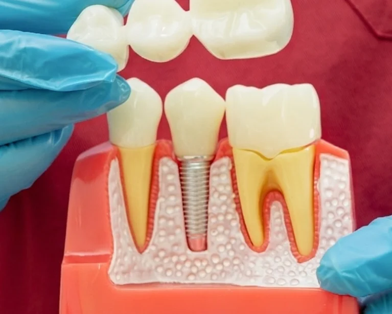Emergency Broken Tooth Repair Edmonton